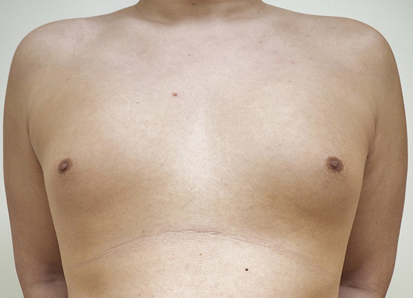 症例2　男性の女性化乳房に対する脂肪吸引 手術前