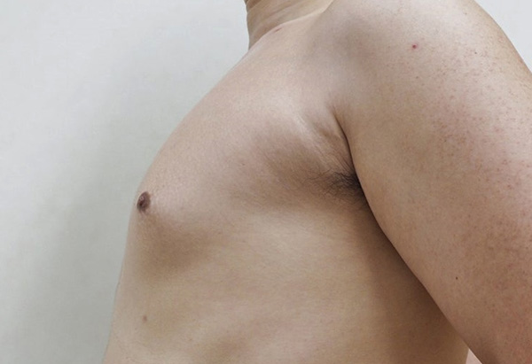 症例2　男性の女性化乳房に対する脂肪吸引 手術後
