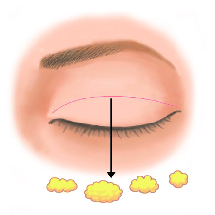 脂肪注入後のまぶたのしこり除去1
