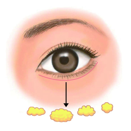 脂肪注入後のまぶたのしこり除去2