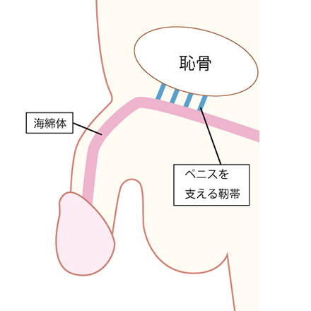 靭帯延長固定長茎術1