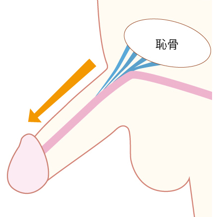 靭帯延長固定長茎術2