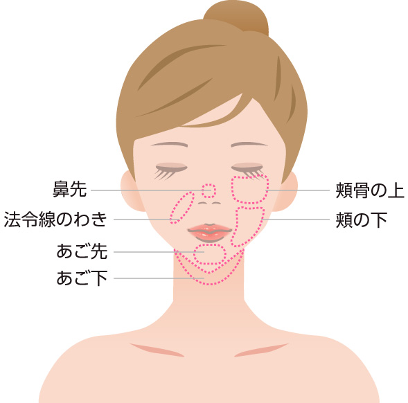 脂肪溶解注射（カベリン）1