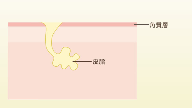 ニキビができるしくみ1