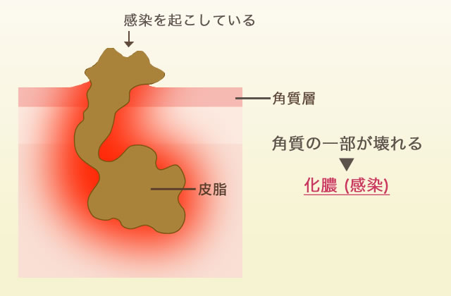 ニキビができるしくみ4