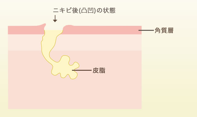 ニキビができるしくみ5