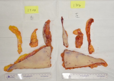 脂肪吸引＋腹壁形成2e.JPG