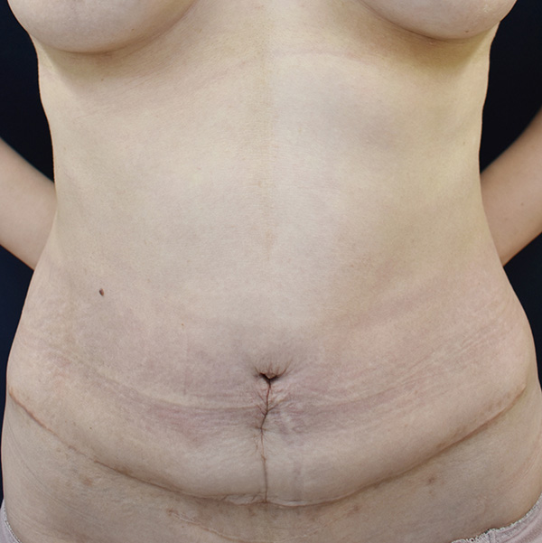 症例2　腹部の脂肪吸引＋腹壁形成術（タミータック手術） 手術後